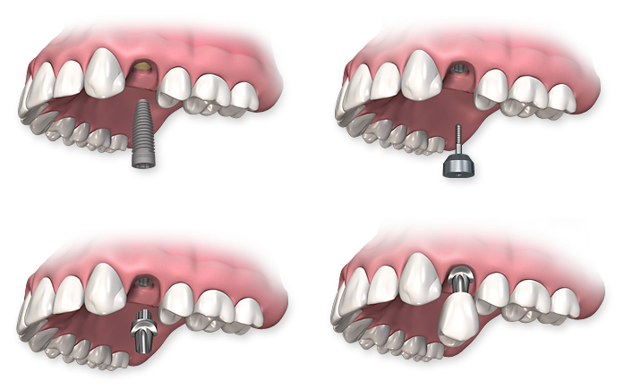 Flap & Gum Surgeries