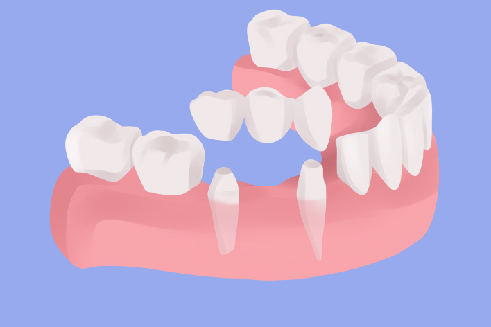 Flap & Gum Surgeries