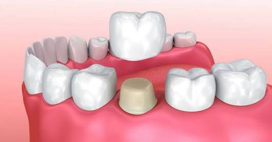 Flap & Gum Surgeries