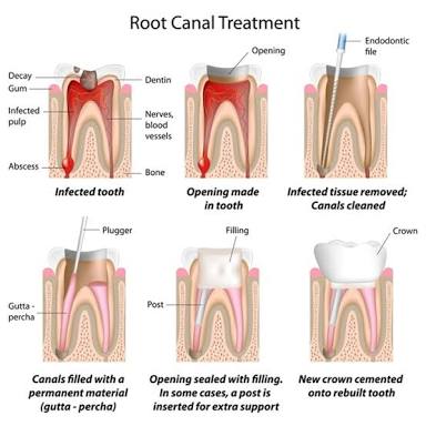 Flap & Gum Surgeries