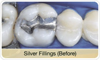 Flap & Gum Surgeries