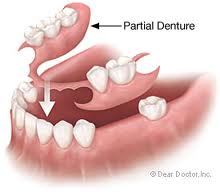 Flap & Gum Surgeries