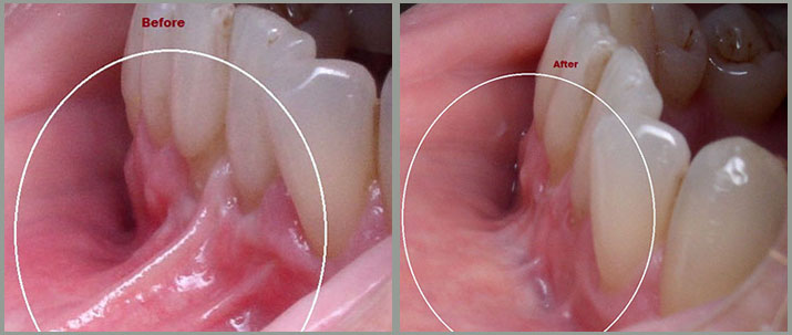 Flap & Gum Surgeries