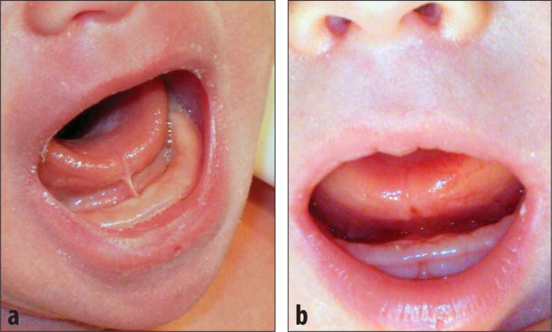 Flap & Gum Surgeries