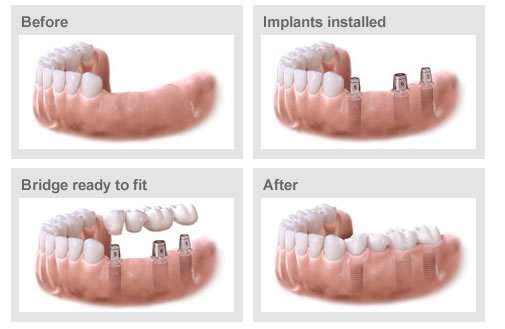 Flap & Gum Surgeries