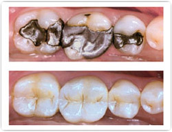 Flap & Gum Surgeries