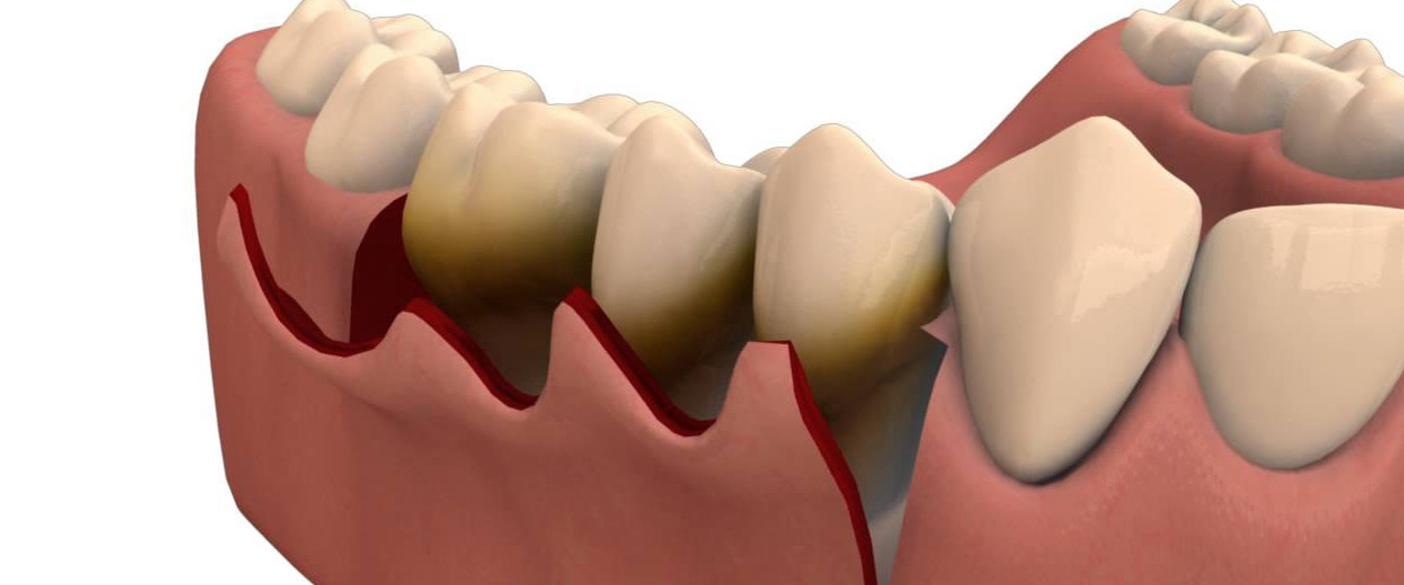 Flap & Gum Surgeries