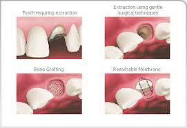 Flap & Gum Surgeries