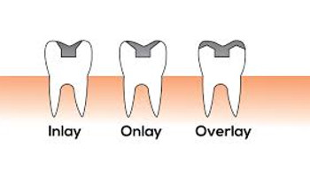 Flap & Gum Surgeries