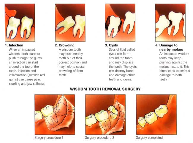 Flap & Gum Surgeries