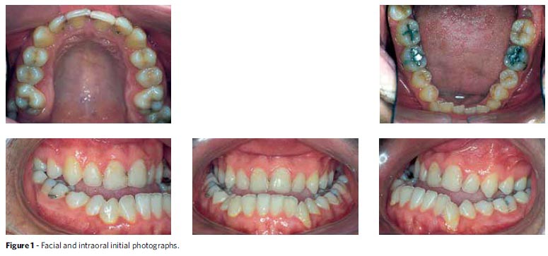 Flap & Gum Surgeries