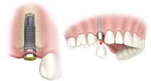 Flap & Gum Surgeries