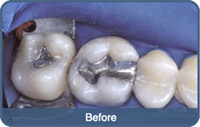 Flap & Gum Surgeries