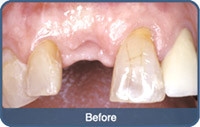 Flap & Gum Surgeries