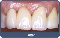 Flap & Gum Surgeries