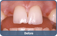 Flap & Gum Surgeries