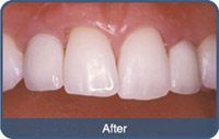 Flap & Gum Surgeries