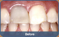 Flap & Gum Surgeries