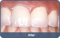 Flap & Gum Surgeries