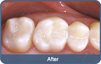 Flap & Gum Surgeries