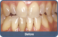 Flap & Gum Surgeries