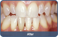 Flap & Gum Surgeries