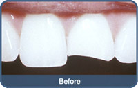 Flap & Gum Surgeries