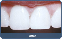 Flap & Gum Surgeries